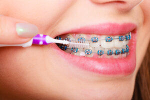 Leia mais sobre o artigo Ortodontia: Quanto custa colocar aparelhos nos dentes?