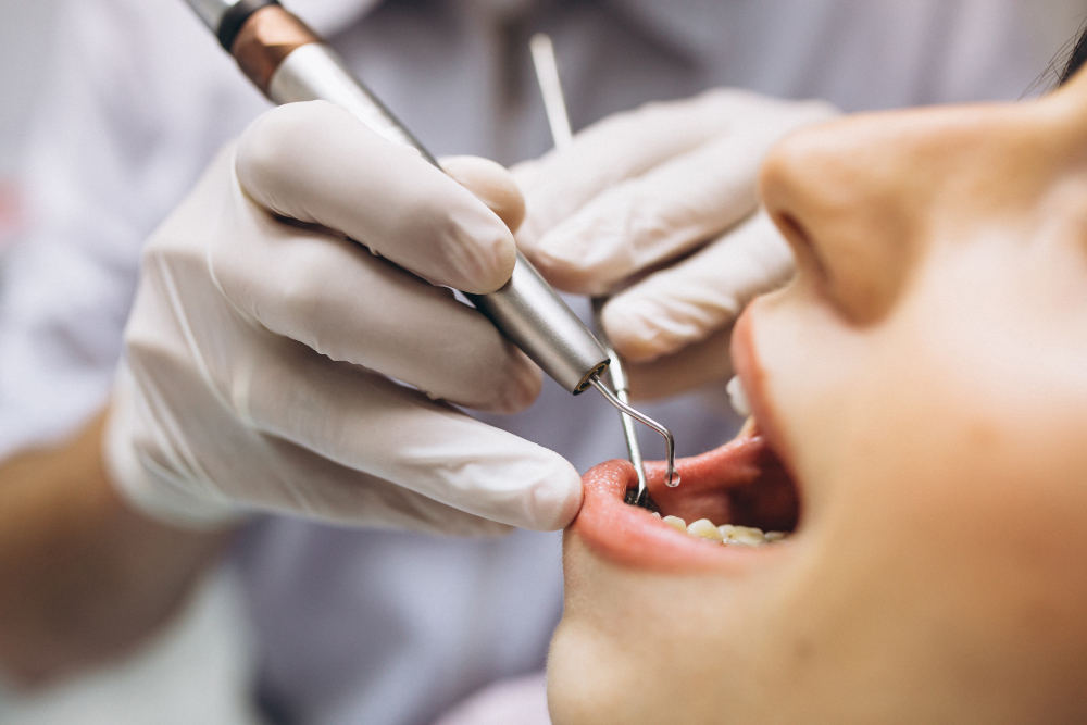 Quais são os benefícios da limpeza de dentes? 3 dentista